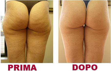 Mesoterapia Pescara